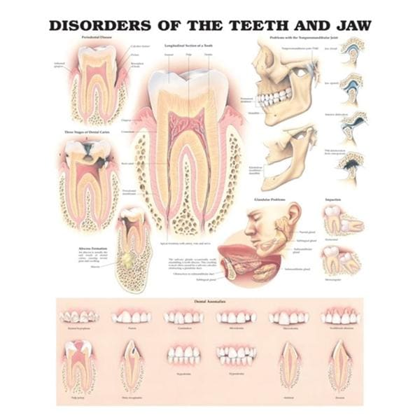 Poster Disorders of the Teeth and Jaw 20 in x 26 in With Lamination Ea