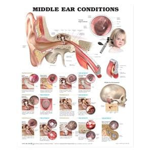 Middle Ear Conditions 20x26" Anatomical Chart EA