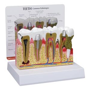 Patient Education Model Diseased Teeth & Gum 6 in x 6 in x 5.5 in Ea