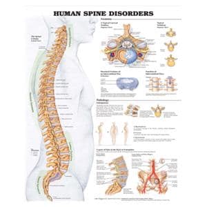 Spine Disorder 20x26" Clinical Chart Ea