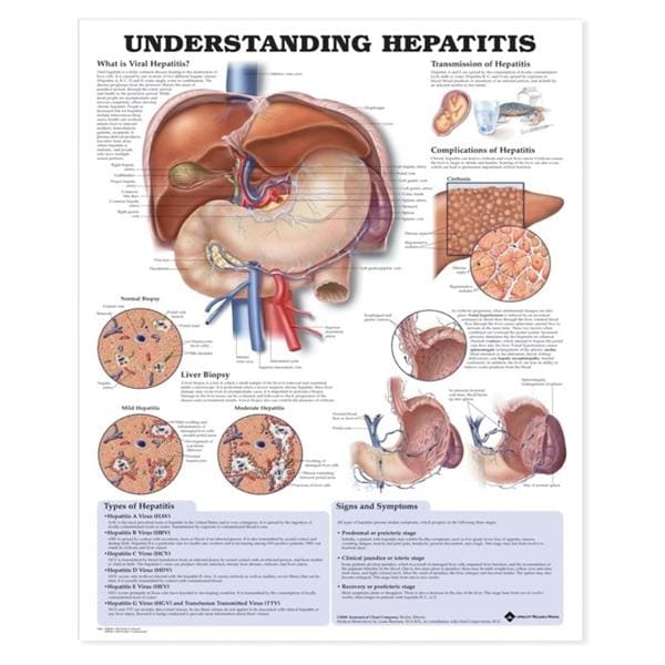 Understanding Hepatitis 20x26" Educational Chart Ea