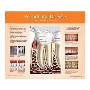 Poster Periodontal Disease 16 in x 20 in With Lamination Ea