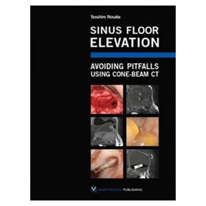 Book Sinus Floor Elevation: Avoiding Pitfalls Using Cone-Beam CT Ea