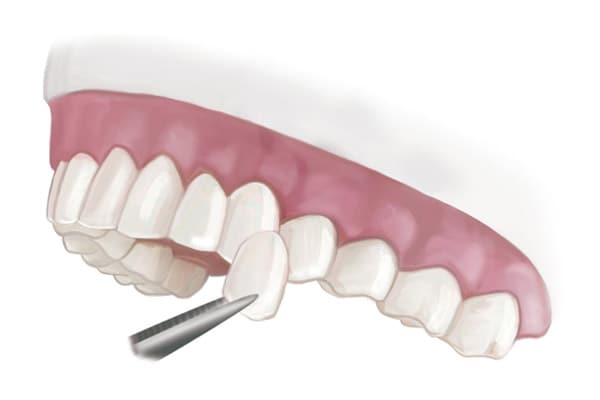 porcelain veneers and dental veneers